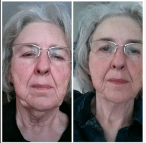 Before and after results of red light therapy
